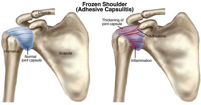 You are currently viewing Frozen Shoulder: Causes And How Physical Therapy Can Help.
