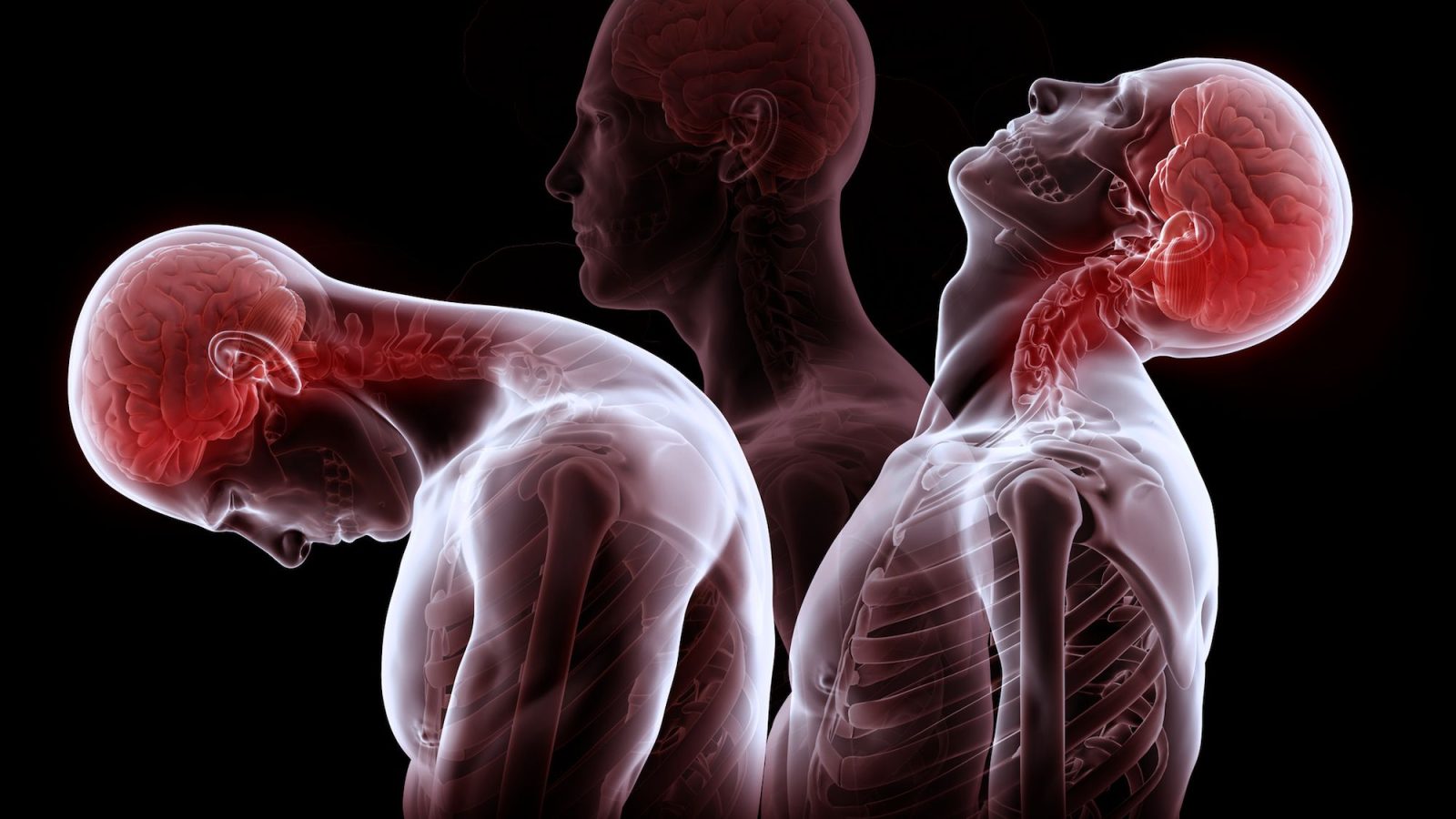 Whiplash: Symptoms, Causes, and Effective Physical Therapy Treatments.