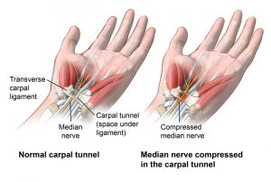 Essential Benefits of Chiropractic Care For Carpal Tunnel Syndrome(CTS).