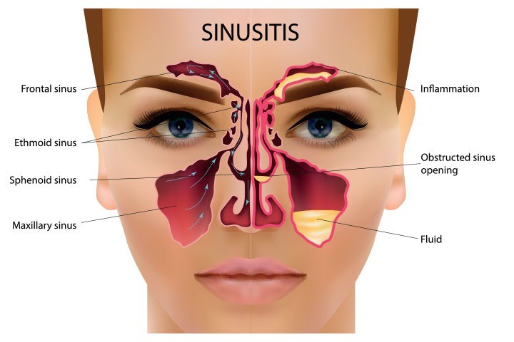 Read more about the article Relieving Sinus Infection(Sinusitis) With Chiropractic Care